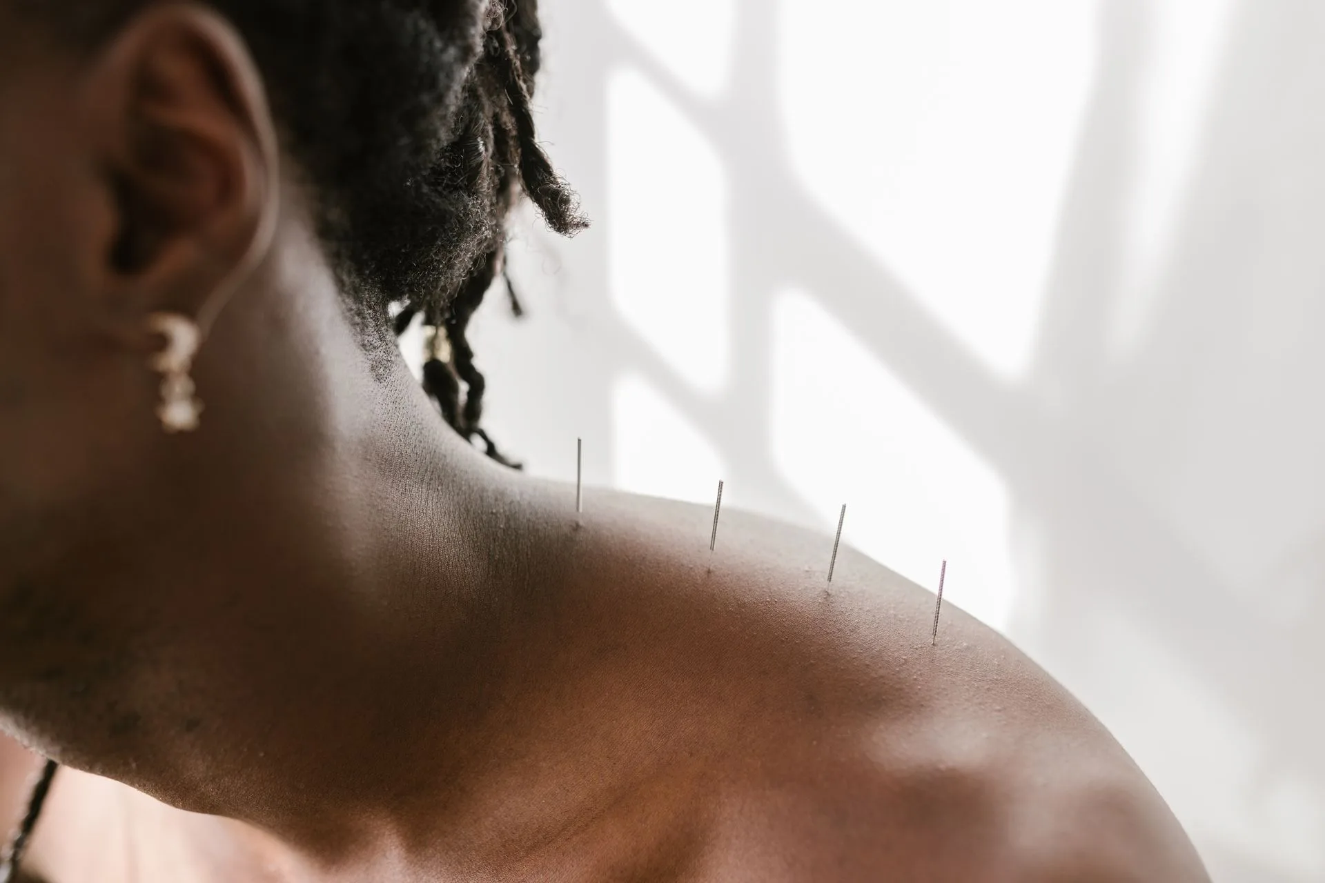 Fine acupuncture needles placed along a client's shoulder during treatment